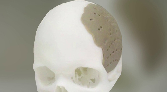 3D yazıcıdan çıkan kafatası parçası