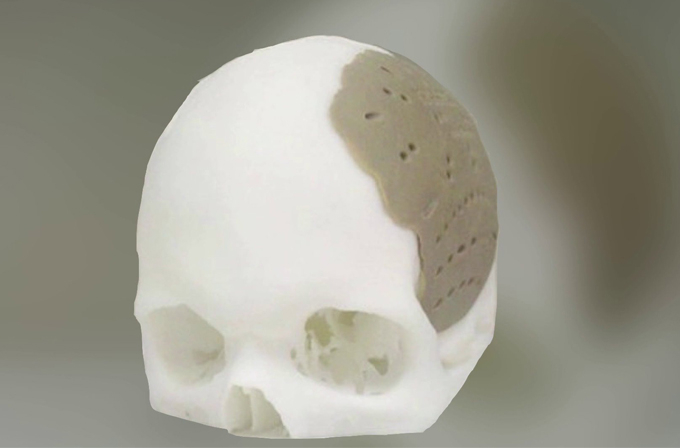 3D yazıcıdan çıkan kafatası parçası