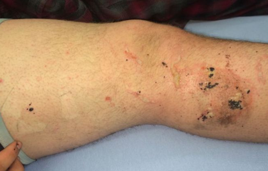 Apple-iPhone-catches-fire-burns-teenager