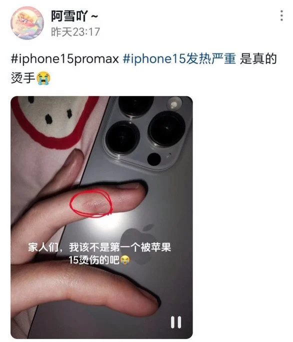 iPhone 15 aşırı ısınma sorunu yüzünden kullanıcılarda yanık oluyor
