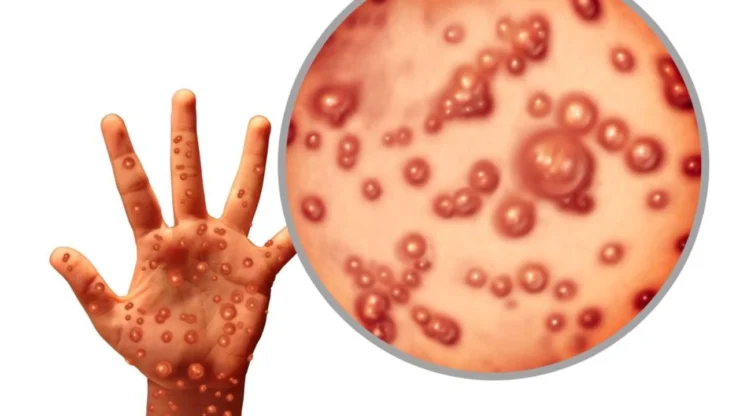 Maymun Çiçeği Virüsü